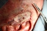 Before and after Mohs removal of a complicated squamous cell carcinoma
