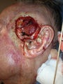Before and after Mohs removal of a complicated squamous cell carcinoma