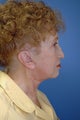 face/neck lift