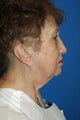 face/neck lift