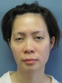 Chin Surgery on 32-year-old