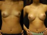 18 yr old woman, saline 270 filled to 300, 4 months post op