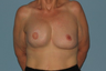 This Breast Reconstruction patient had reconstruction on the right breast and reduction on the left.