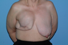 This Breast Reconstruction patient had reconstruction on the right breast and reduction on the left.