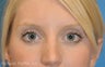 Lower Blepharoplasty at young age -fat pad removal only (eye bags)
