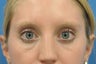 Lower Blepharoplasty at young age -fat pad removal only (eye bags)