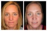 Rhinoplasty