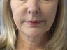 juvederm before and afters