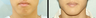 Chin Augmentation