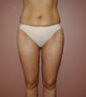 Liposuction of Inner and Outer Thighs and Medial Knee