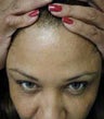 Female Botox Patient
