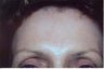 Botox