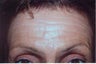 Botox