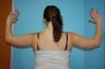 Arm Lift