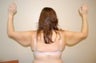 Arm Lift