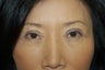 Asian Eyelids