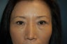 Asian Eyelids