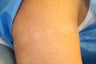 40 Year Old Female Tattoo Removal