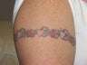 40 Year Old Female Tattoo Removal