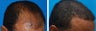 Hair Transplant Before & After - 46 Year-Old Male, 2600 Grafts, 20 Months Post Op