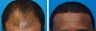Hair Transplant Before & After - 46 Year-Old Male, 2600 Grafts, 20 Months Post Op