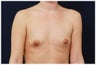 Breast Augmentation