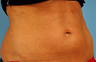 truSculpt