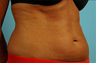 truSculpt