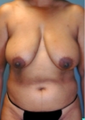 Breast Reconstruction