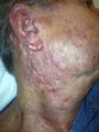 67 year old male with extensive hemangioma of face, neck and ear