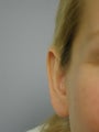 Otoplasty