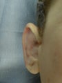 Otoplasty