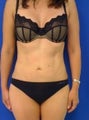Laser Liposuction