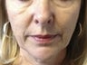 46 year old woman treated with juvederm - Nasolabial folds