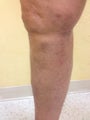 55 year old male with varicose veins treated by EVLT