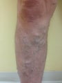 55 year old male with varicose veins treated by EVLT