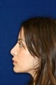 Rhinoplasty Before and After