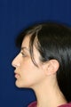 Rhinoplasty Before and After