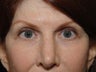 Upper Lid Eyelid Surgery