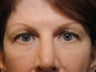 Upper Lid Eyelid Surgery