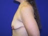 Breast Lift