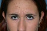 Botox