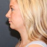 Chin Implant