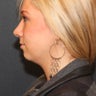 Chin Implant