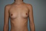 Bilateral Breast Augmentation