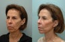 Facial Reconstructive Surgery