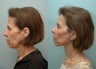 Facial Reconstructive Surgery