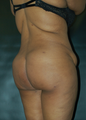 Liposuction to Back and Brazilian Butt Lift