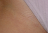 Laser Hair Removal