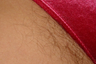 Laser Hair Removal